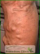 varicose vein